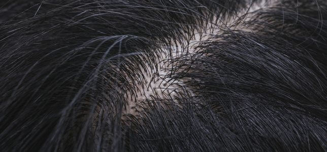 頭皮の乾燥は薄毛や臭いの原因に？！乾燥する原因と解消法