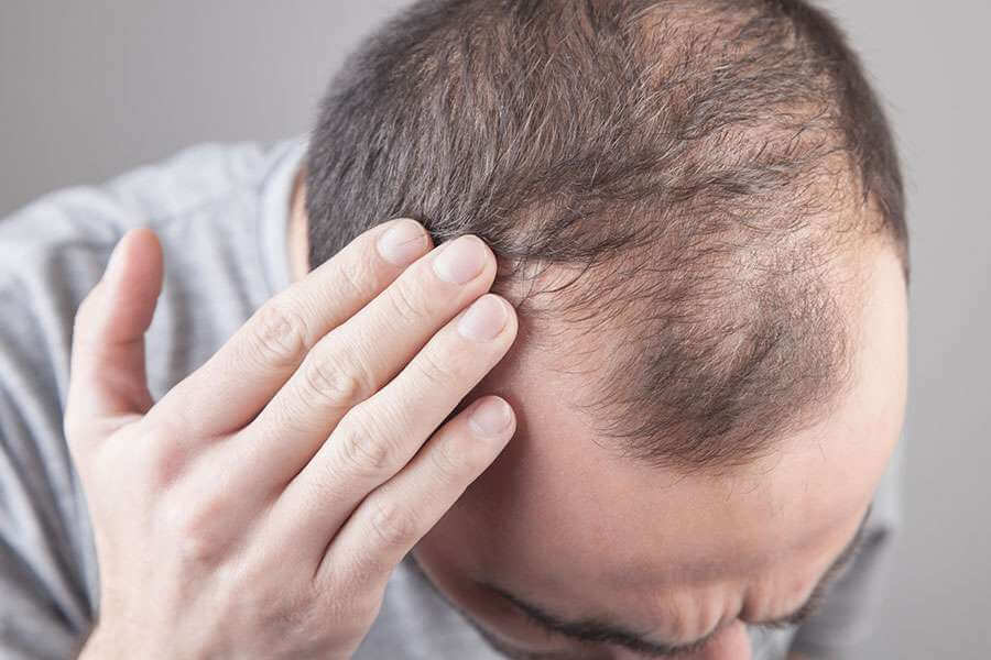 AGA（男性型脱毛症）とは？薄毛・抜け毛が増える進行性の脱毛症