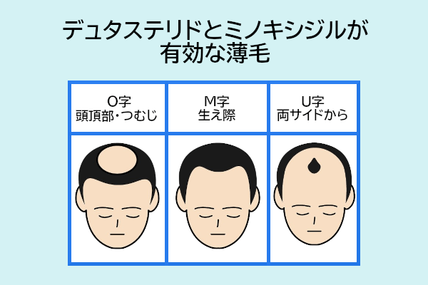 デュタステリドとミノキシジルが有効な薄毛